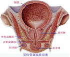 前列腺增生