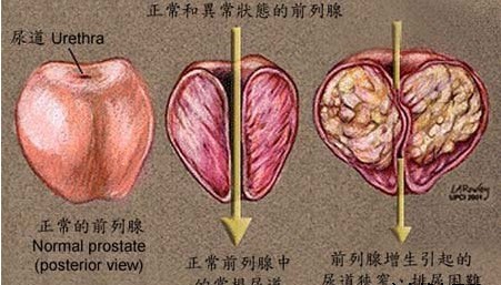 前列腺增生检查