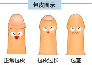 湖南性保健治疗包皮过长