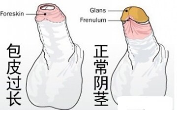 治疗包皮过长