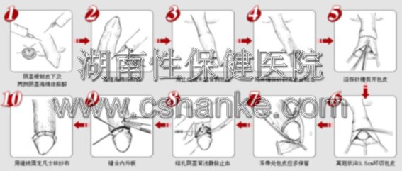 包皮切除，让您的伴侣更健康！