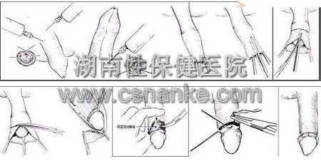 湖南性保健割包皮