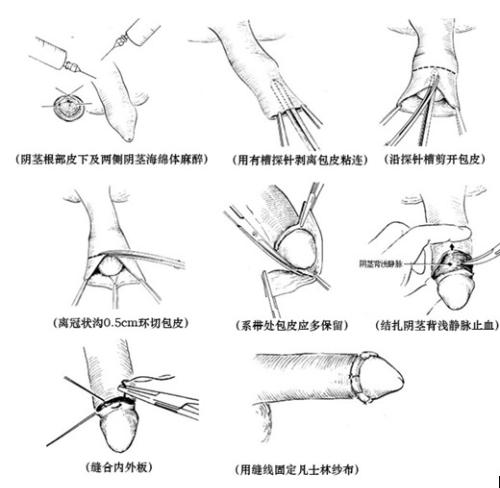 男性青少年包皮过长需要手术吗