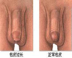 男人包皮过长的症状有哪些呢？