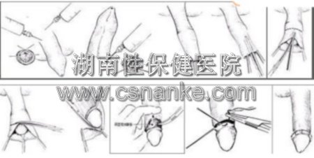 包皮过长