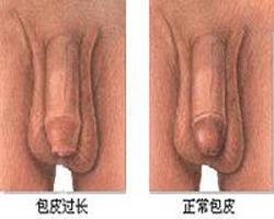 包皮手术费用通常是多少