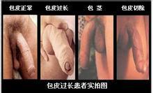 包皮过长不割有什么影响