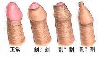 包皮过长不割行吗
