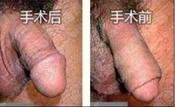 做包皮手术有危险吗