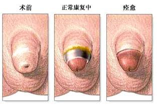 男性包皮过长怎么办