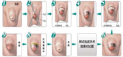 包皮手术