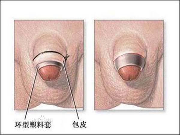 夏天做包皮手术好不好