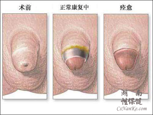 包皮过长术后与术前对比图