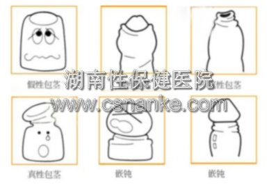 包茎的症状、分类、检查以及应该采取的治疗手段 