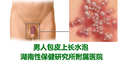 男人包皮上长水泡