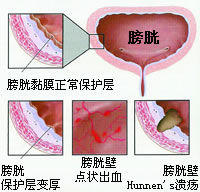 治疗膀胱炎全国前三的方法是什么