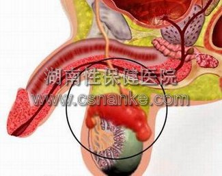 附睾炎的治疗