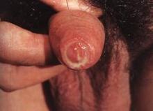 急性淋病性尿道炎