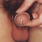 继发淋病性龟头炎