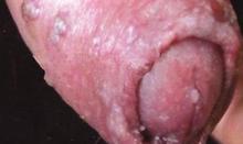 急性淋病性尿道炎