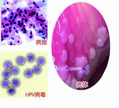 男人生殖器上长小肉芽是怎么回事