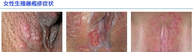 女性生殖器疱疹