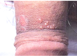 男性生殖器疱疹症状