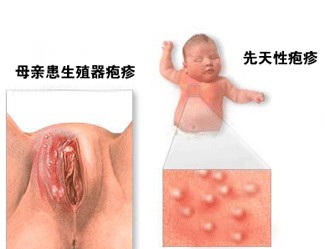 铜仁生殖器疱疹治疗?