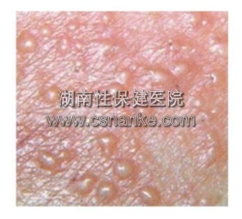 湖南性保健治疗生殖器疱疹