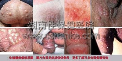 湖南性保健治疗生殖器疱疹