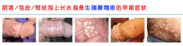不幸邂逅，感染生殖器疱疹能治愈吗？