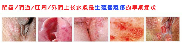 不幸邂逅，感染生殖器疱疹能治愈吗？